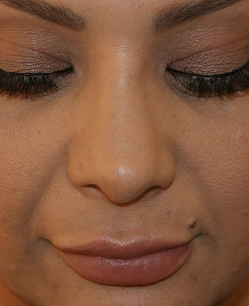 Rhinoplasty Before & After Gallery - Patient 171371 - Image 8