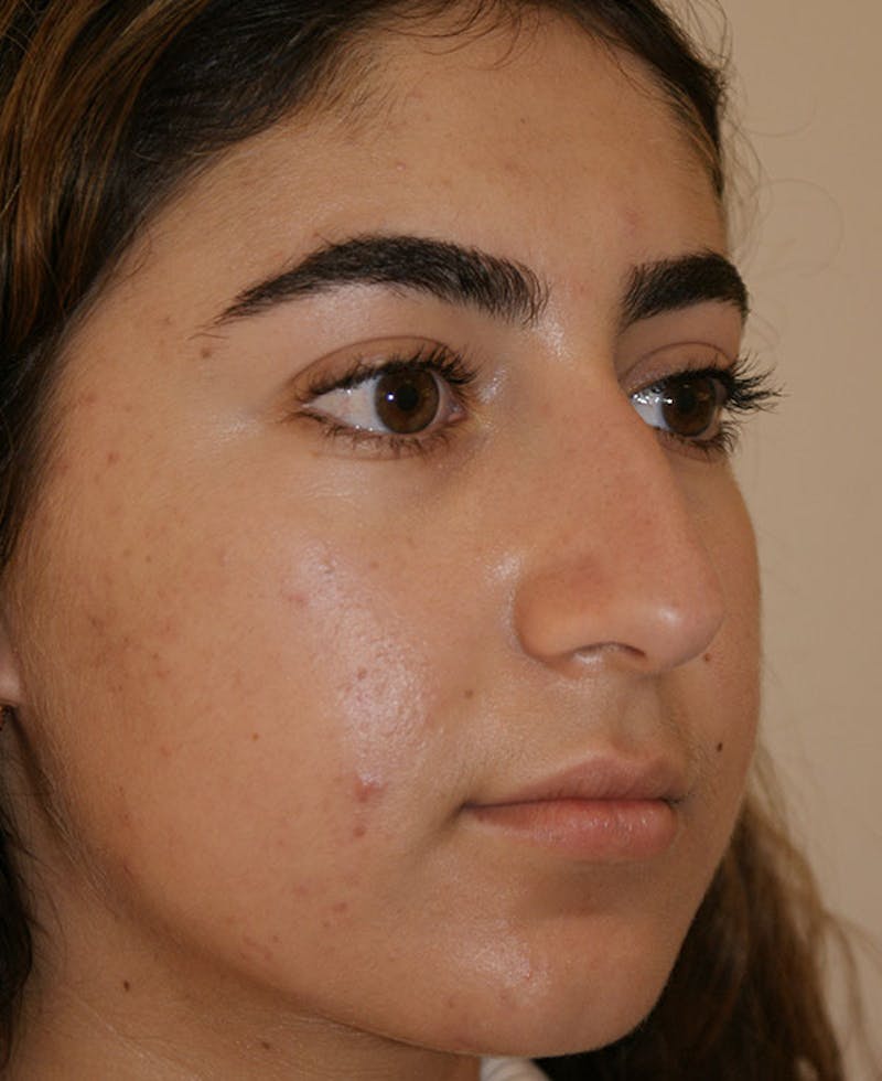 Rhinoplasty Before & After Gallery - Patient 181435 - Image 4