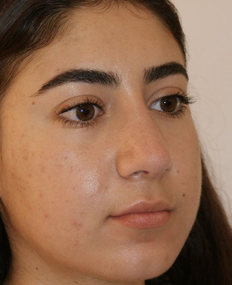 Rhinoplasty Before & After Gallery - Patient 181435 - Image 3
