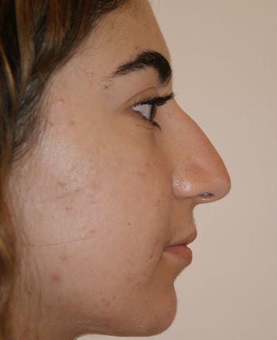 Rhinoplasty Before & After Gallery - Patient 181435 - Image 1