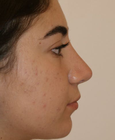 Rhinoplasty Before & After Gallery - Patient 181435 - Image 2