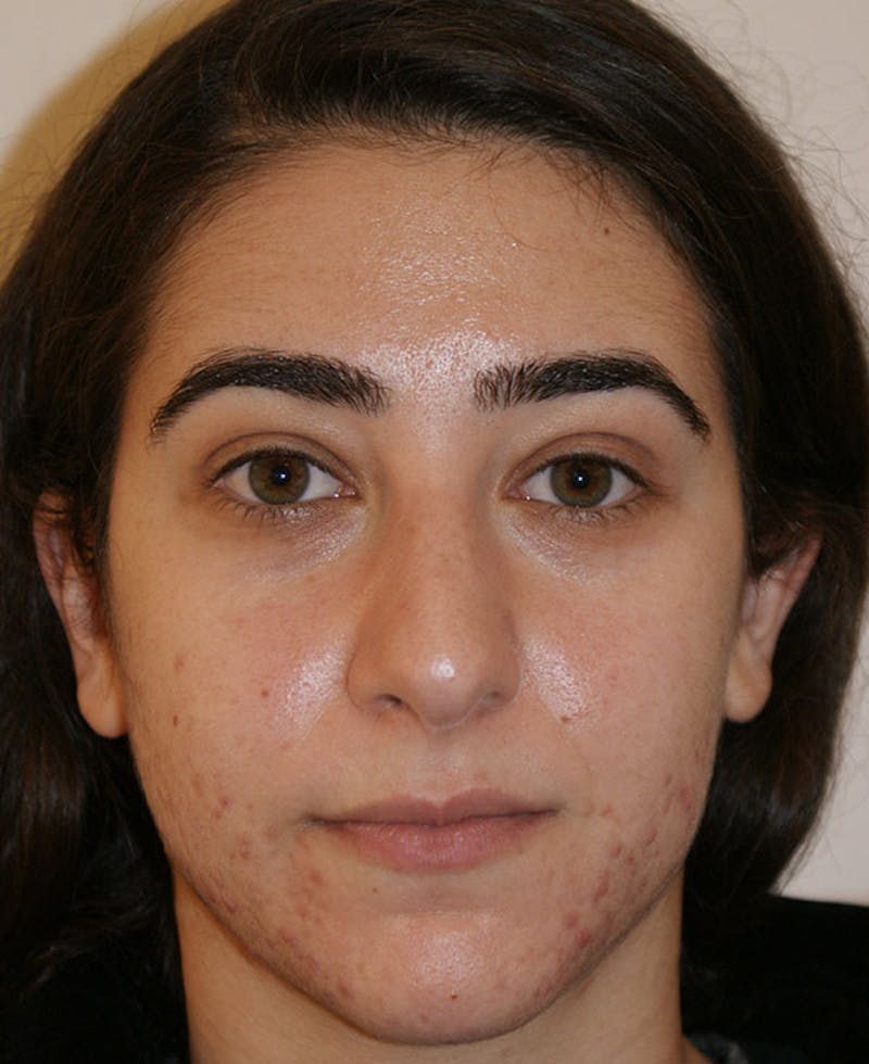 Rhinoplasty Before & After Gallery - Patient 196540 - Image 5