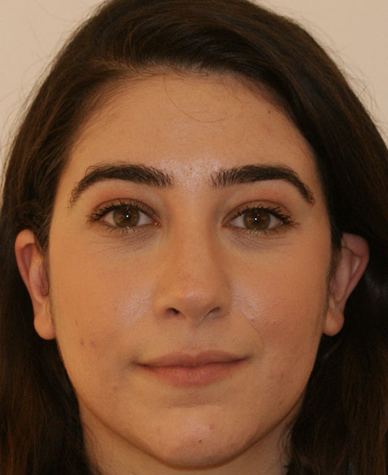 Rhinoplasty Before & After Gallery - Patient 196540 - Image 6