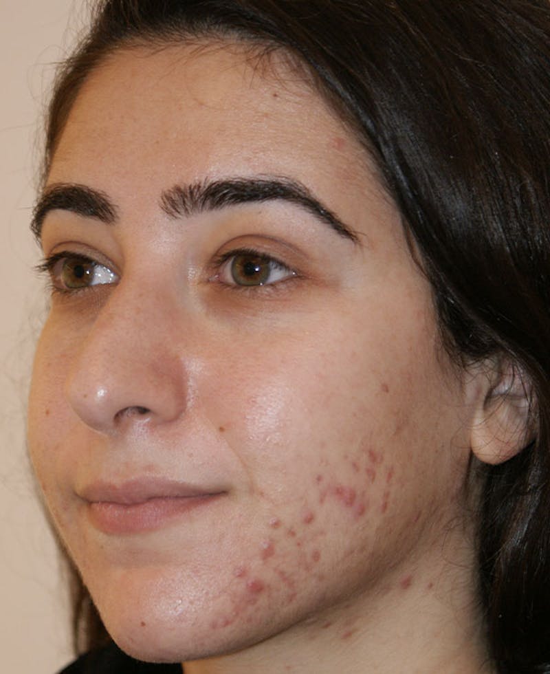 Rhinoplasty Before & After Gallery - Patient 196540 - Image 3