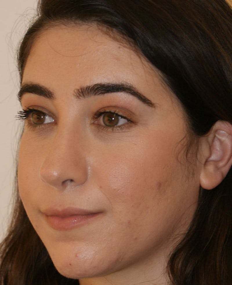 Rhinoplasty Before & After Gallery - Patient 196540 - Image 4