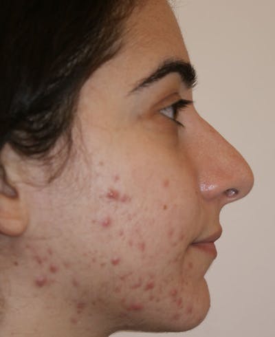 Rhinoplasty Before & After Gallery - Patient 196540 - Image 1