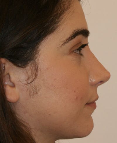 Rhinoplasty Before & After Gallery - Patient 196540 - Image 2