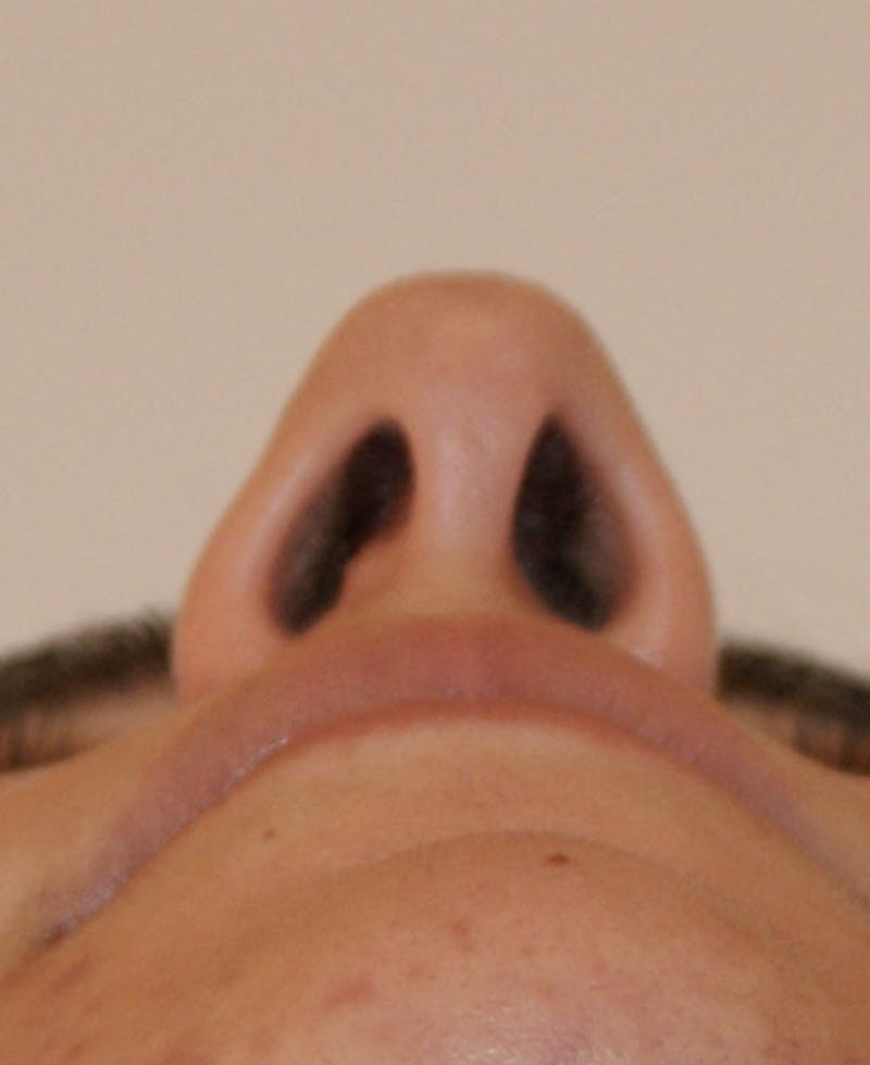 Rhinoplasty Before & After Gallery - Patient 196540 - Image 7