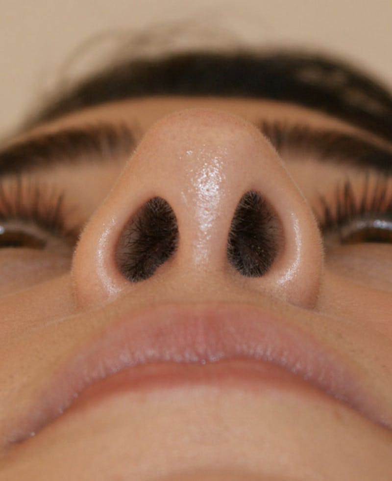 Rhinoplasty Before & After Gallery - Patient 196540 - Image 8