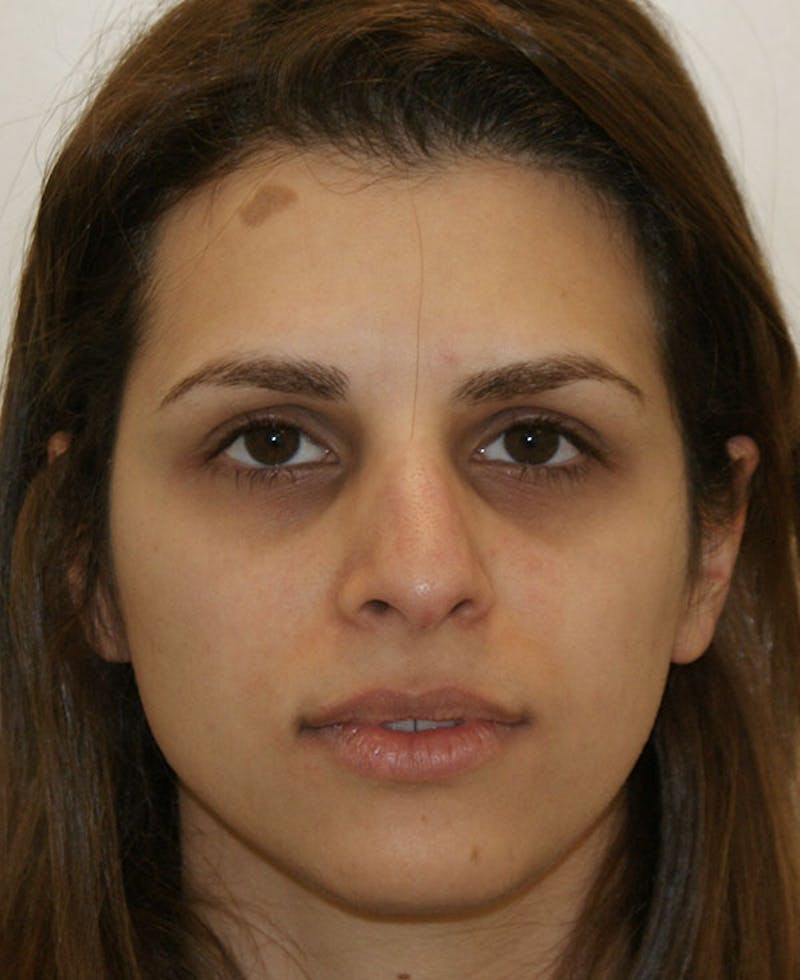 Rhinoplasty Before & After Gallery - Patient 116340 - Image 5