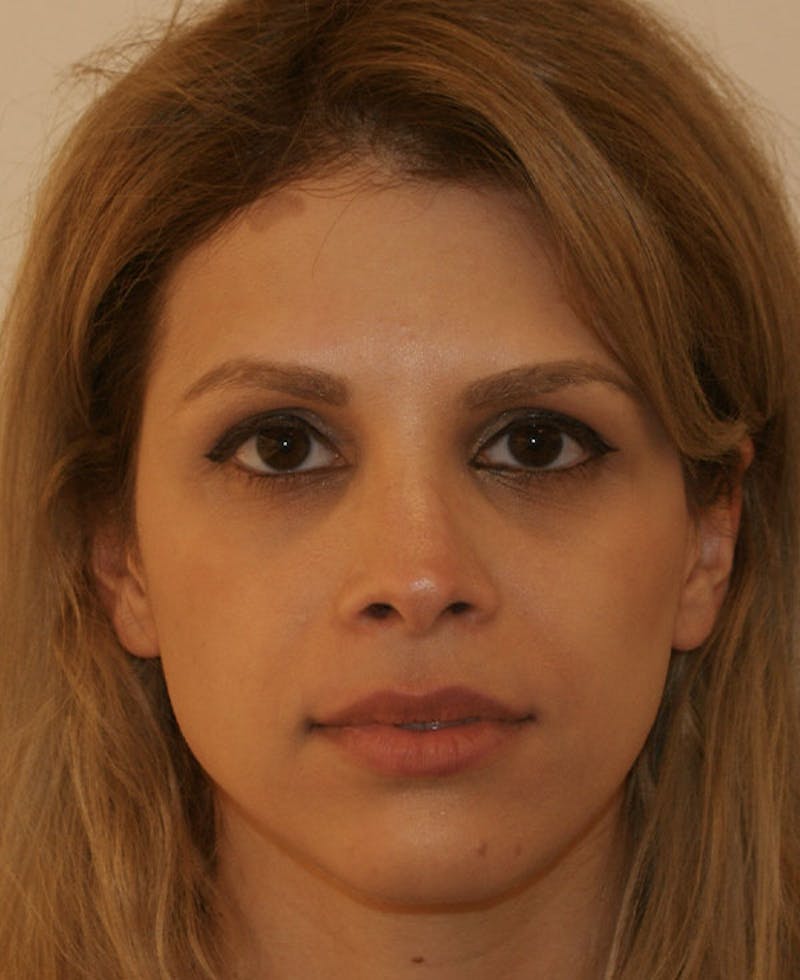 Rhinoplasty Before & After Gallery - Patient 116340 - Image 6