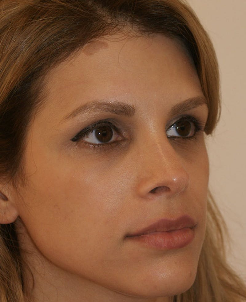 Rhinoplasty Before & After Gallery - Patient 116340 - Image 4
