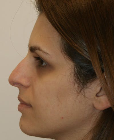 Rhinoplasty Before & After Gallery - Patient 116340 - Image 1