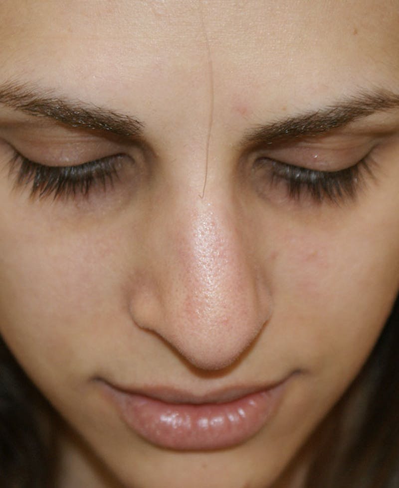 Rhinoplasty Before & After Gallery - Patient 116340 - Image 7