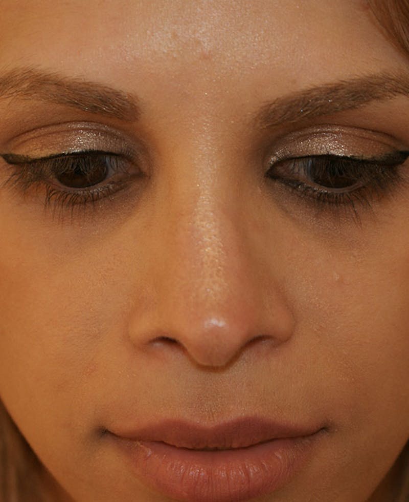 Rhinoplasty Before & After Gallery - Patient 116340 - Image 8