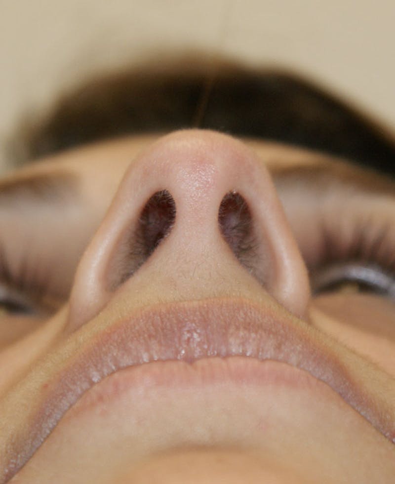 Rhinoplasty Before & After Gallery - Patient 116340 - Image 9