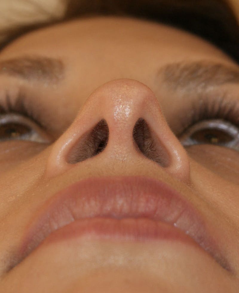 Rhinoplasty Before & After Gallery - Patient 116340 - Image 10