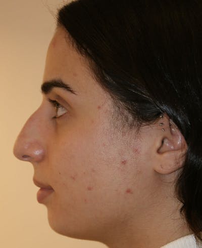 Rhinoplasty Before & After Gallery - Patient 211135 - Image 1