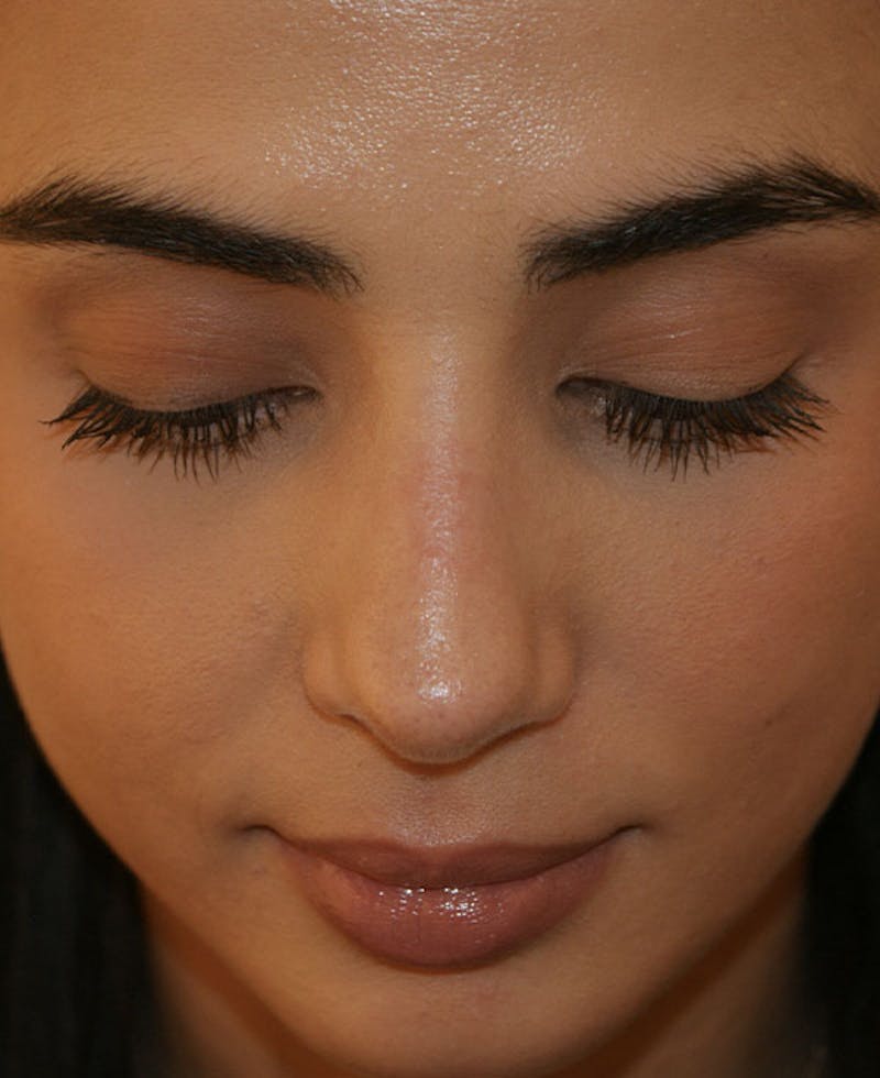 Rhinoplasty Before & After Gallery - Patient 211135 - Image 8