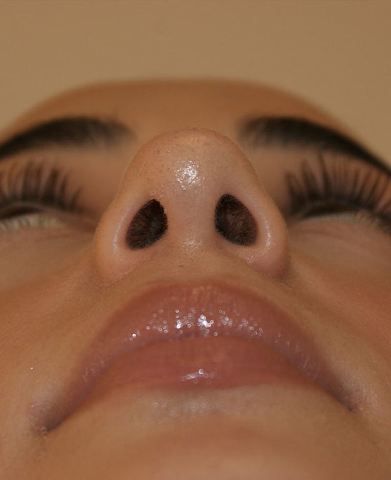 Rhinoplasty Before & After Gallery - Patient 211135 - Image 10