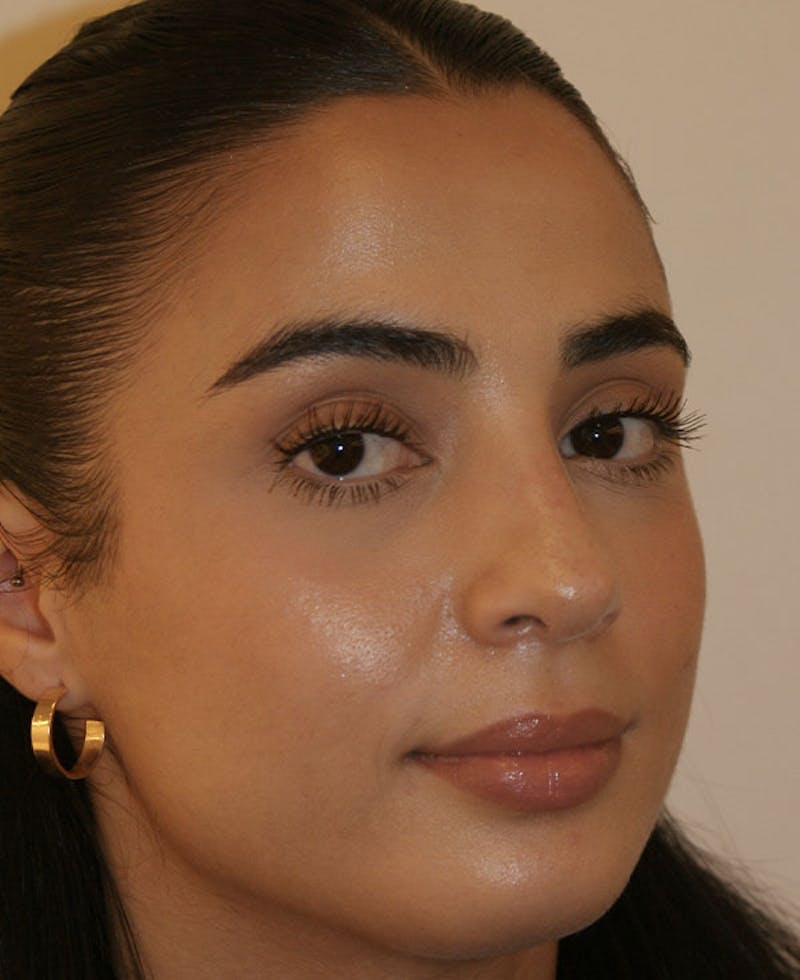 Rhinoplasty Before & After Gallery - Patient 211135 - Image 4