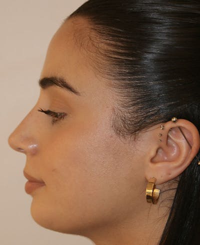 Rhinoplasty Before & After Gallery - Patient 211135 - Image 2