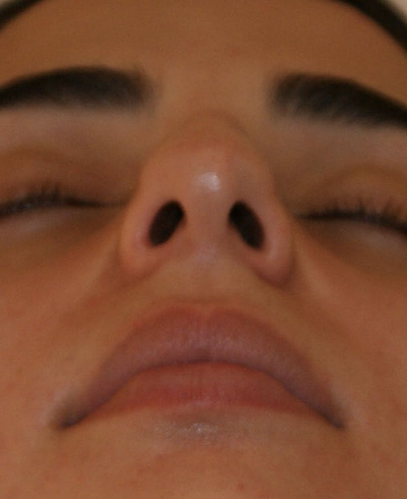 Rhinoplasty Before & After Gallery - Patient 211135 - Image 9