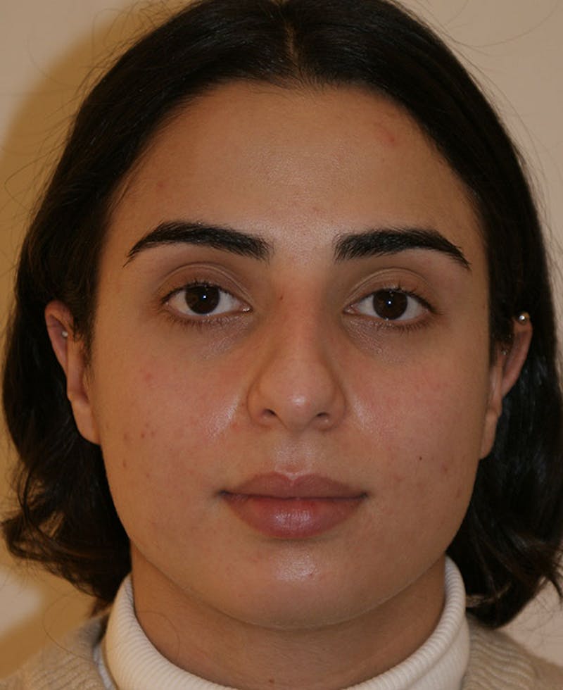 Rhinoplasty Before & After Gallery - Patient 211135 - Image 5