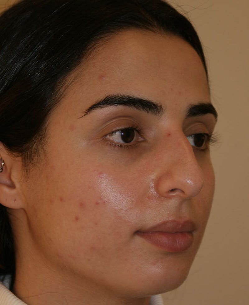Rhinoplasty Before & After Gallery - Patient 211135 - Image 3