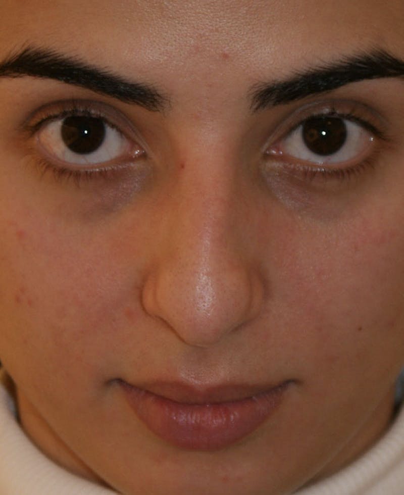Rhinoplasty Before & After Gallery - Patient 211135 - Image 7