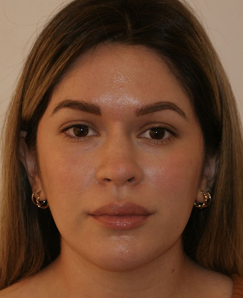Rhinoplasty Before & After Gallery - Patient 130703 - Image 6