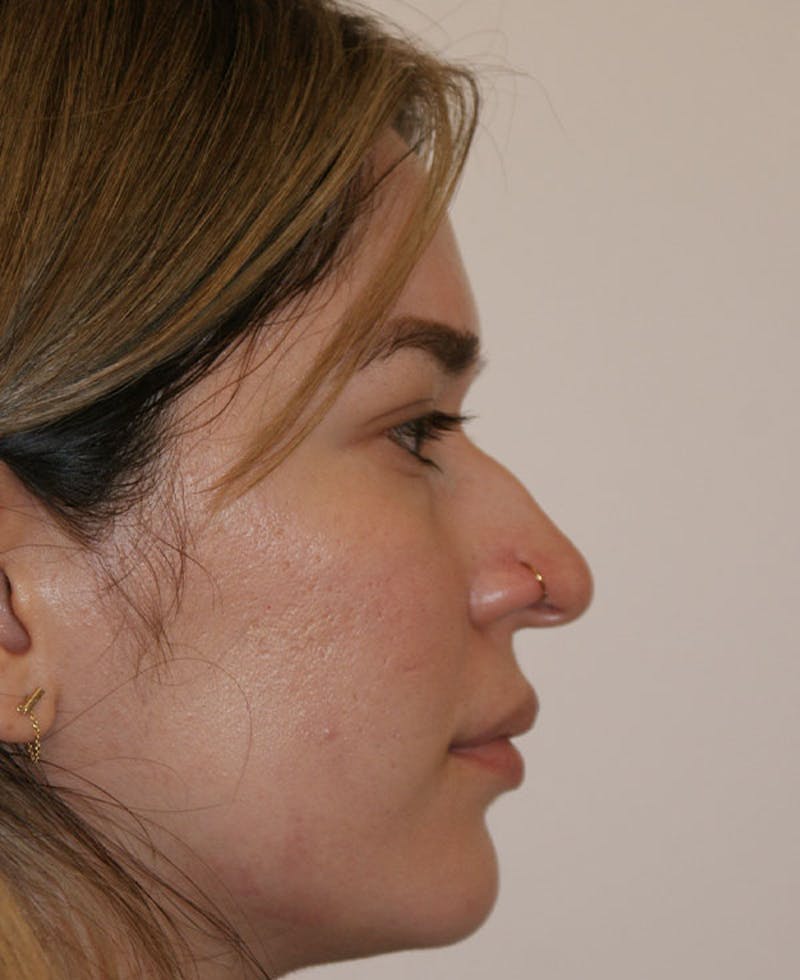 Rhinoplasty Before & After Gallery - Patient 130703 - Image 1