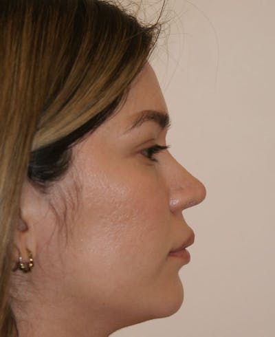 Rhinoplasty Before & After Gallery - Patient 130703 - Image 2