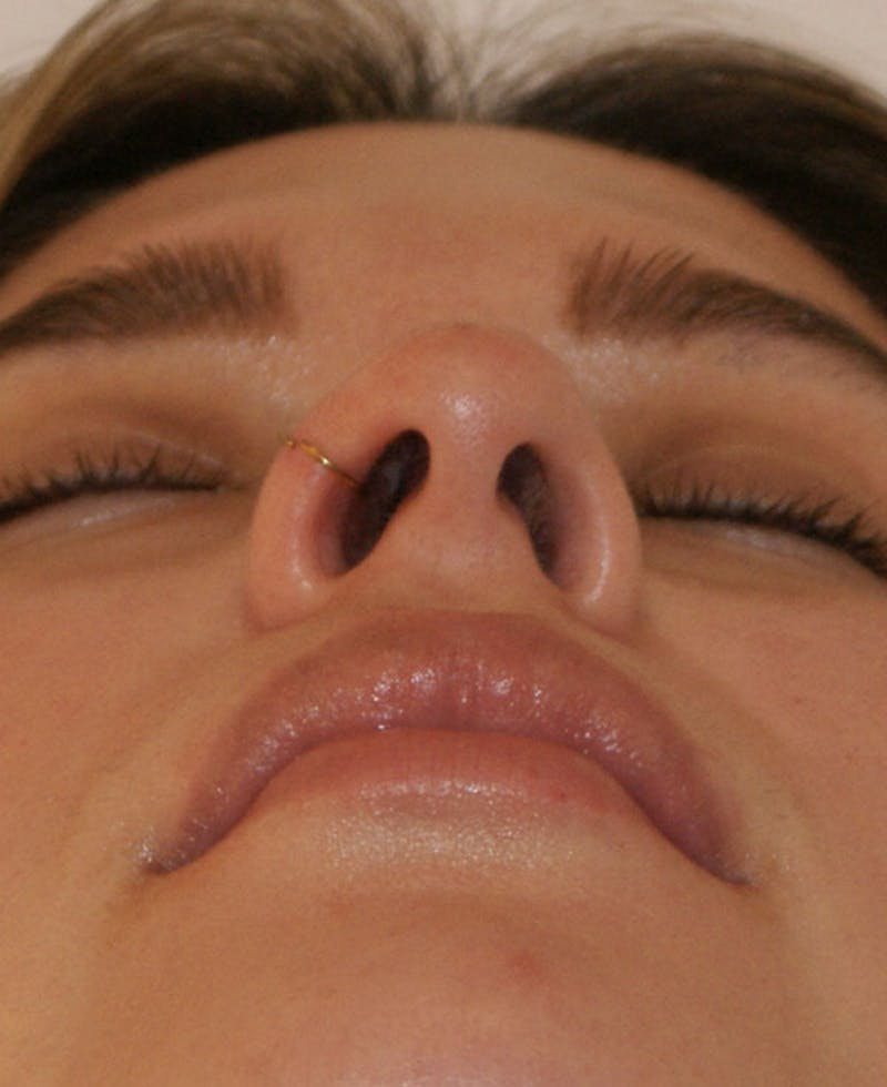 Rhinoplasty Before & After Gallery - Patient 130703 - Image 10