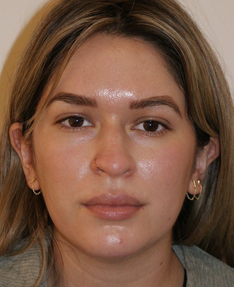 Rhinoplasty Before & After Gallery - Patient 130703 - Image 5