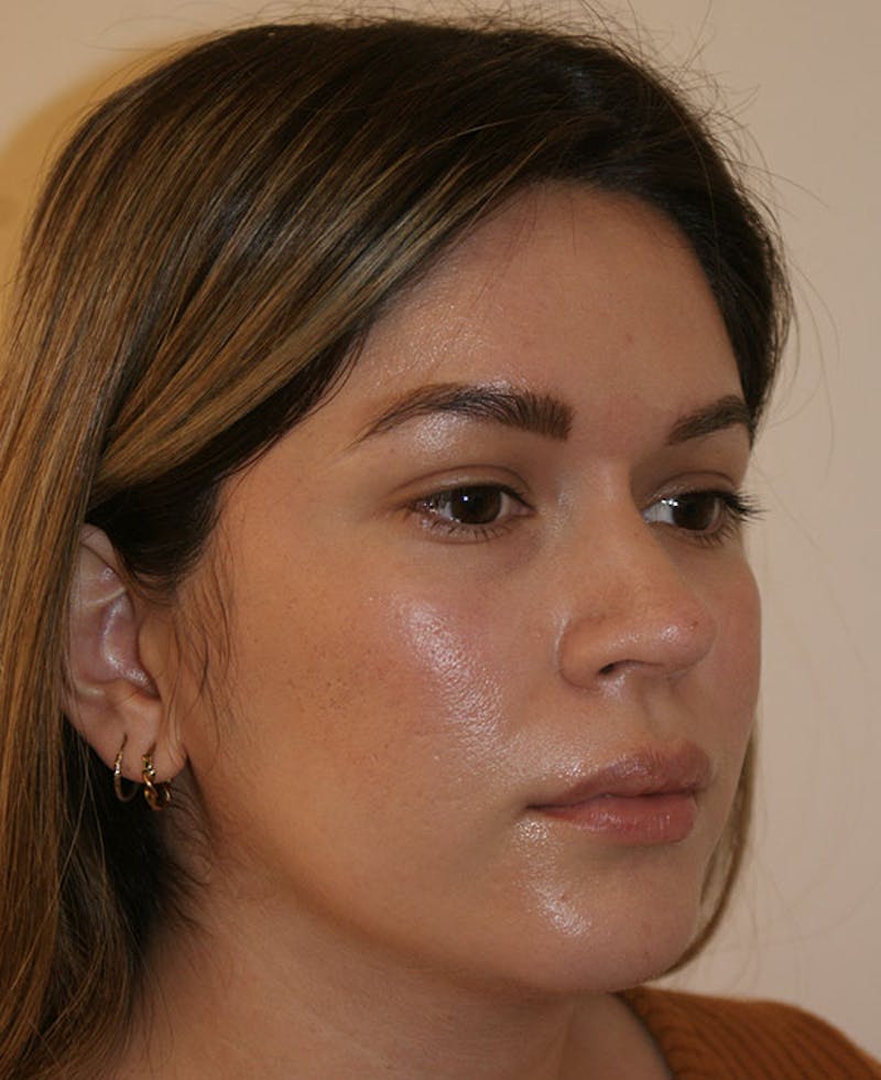 Rhinoplasty Before & After Gallery - Patient 130703 - Image 4