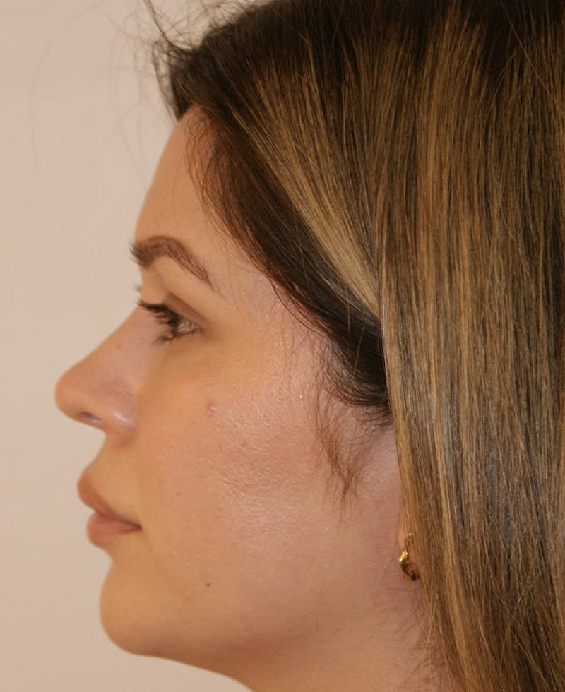 Rhinoplasty Before & After Gallery - Patient 130703 - Image 7