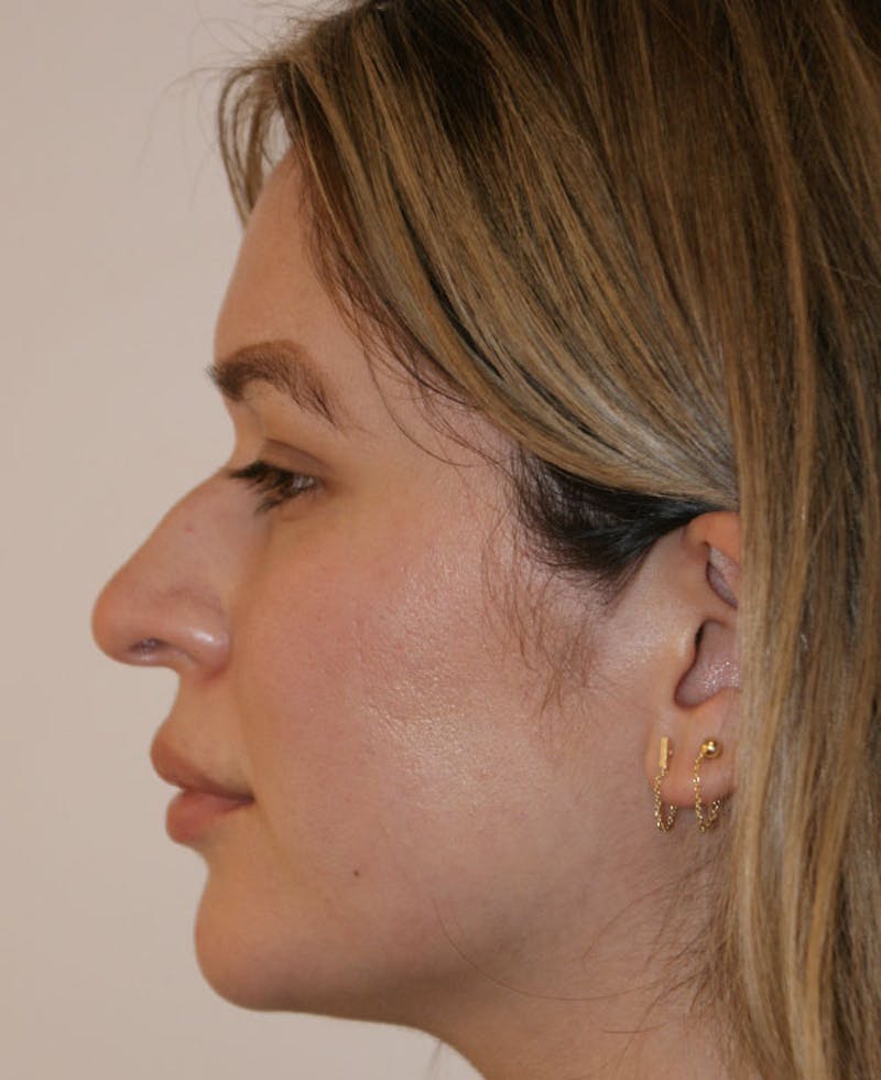 Rhinoplasty Before & After Gallery - Patient 130703 - Image 8