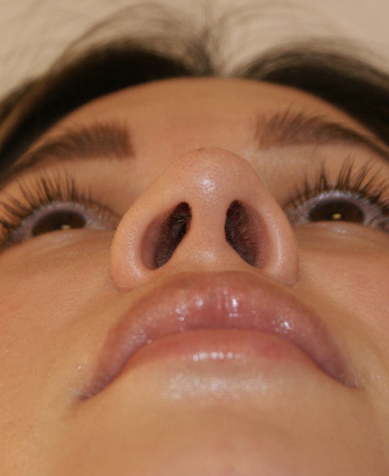 Rhinoplasty Before & After Gallery - Patient 130703 - Image 9