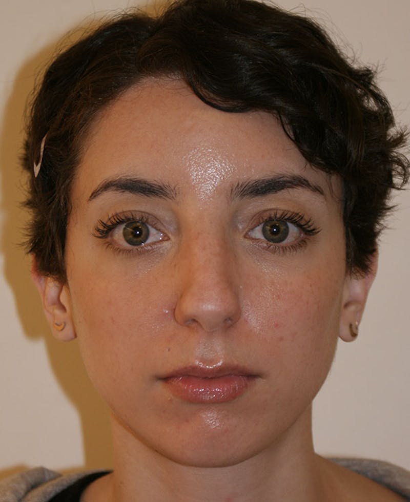 Rhinoplasty Before & After Gallery - Patient 796468 - Image 5