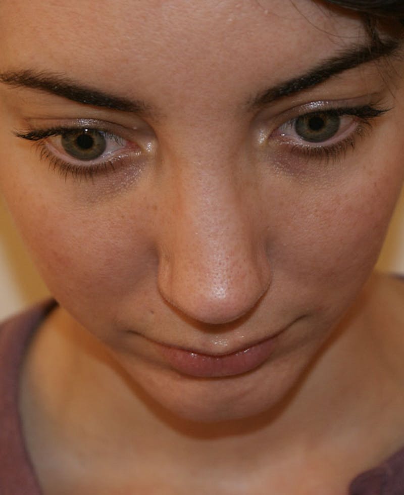 Rhinoplasty Before & After Gallery - Patient 796468 - Image 8