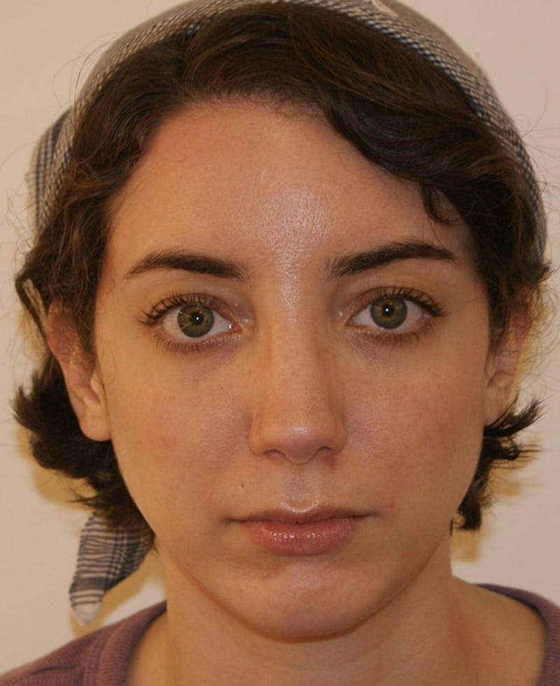 Rhinoplasty Before & After Gallery - Patient 796468 - Image 6