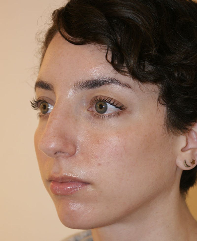 Rhinoplasty Before & After Gallery - Patient 796468 - Image 3