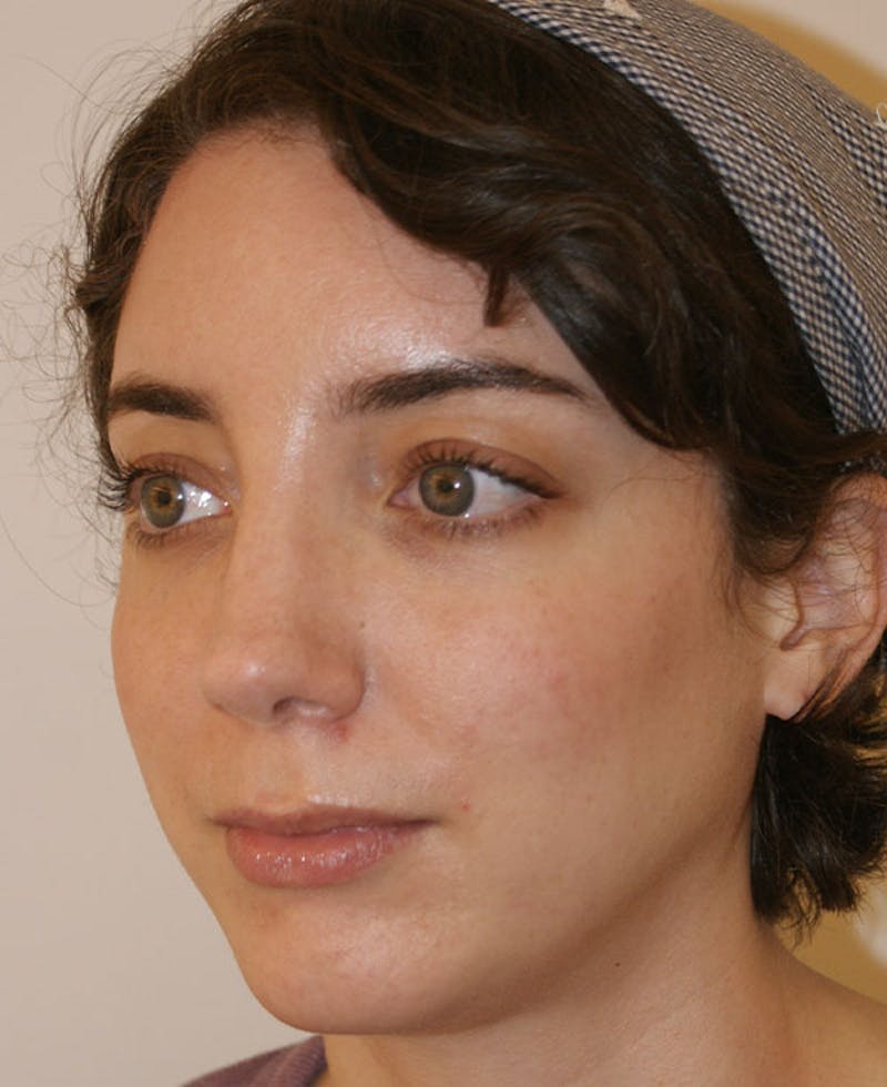 Rhinoplasty Before & After Gallery - Patient 796468 - Image 4