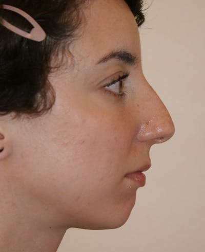 Rhinoplasty Before & After Gallery - Patient 796468 - Image 1