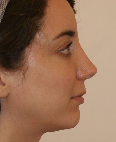 Rhinoplasty Before & After Gallery - Patient 796468 - Image 2