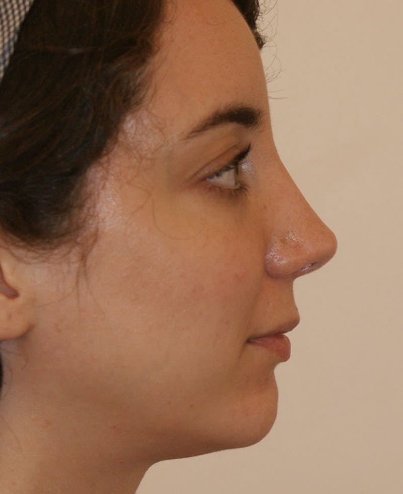 Rhinoplasty Before & After Gallery - Patient 796468 - Image 2
