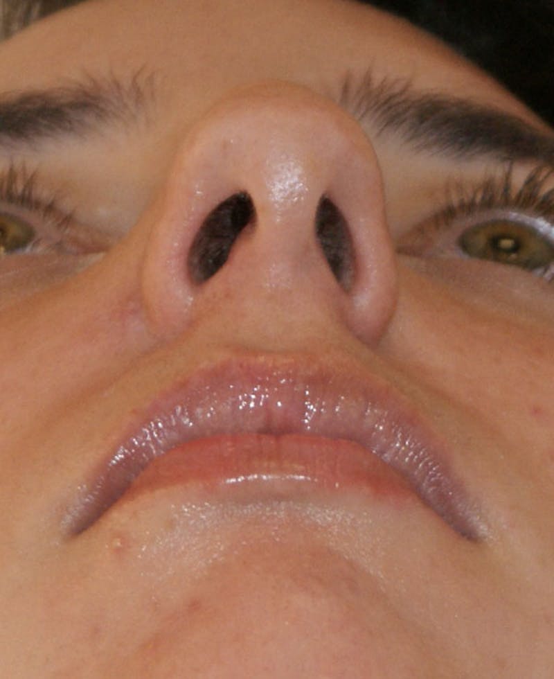 Rhinoplasty Before & After Gallery - Patient 796468 - Image 9