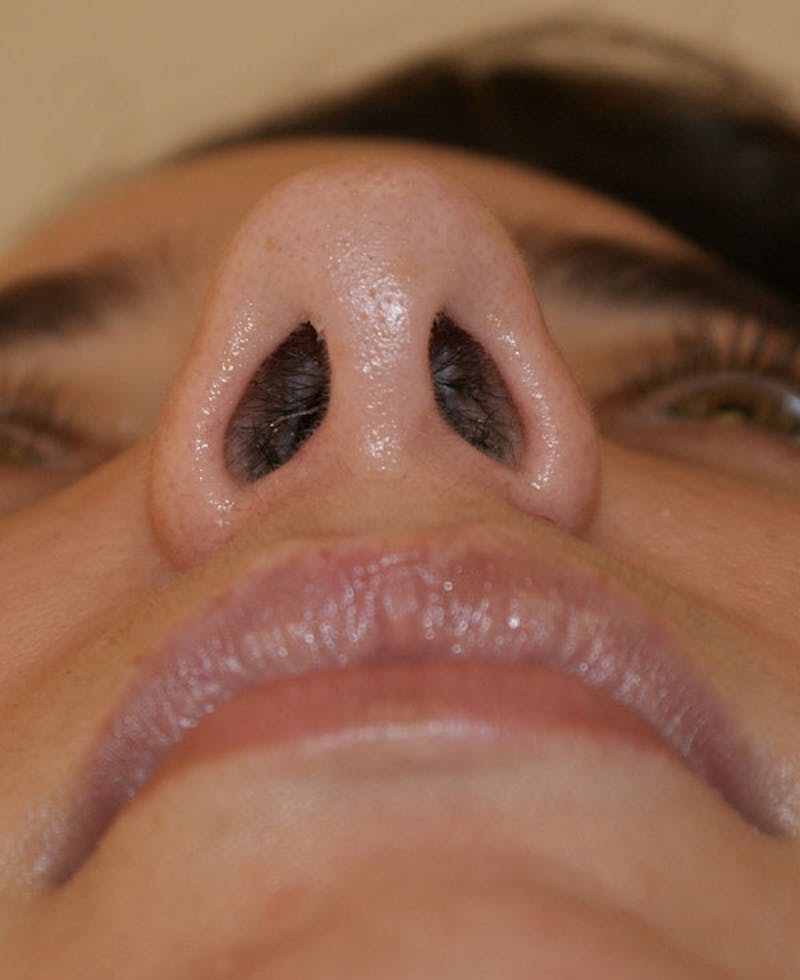 Rhinoplasty Before & After Gallery - Patient 796468 - Image 10
