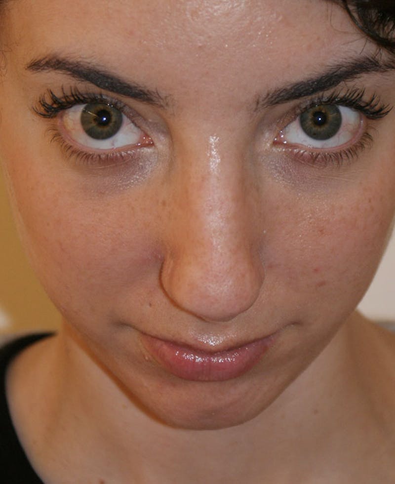 Rhinoplasty Before & After Gallery - Patient 796468 - Image 7
